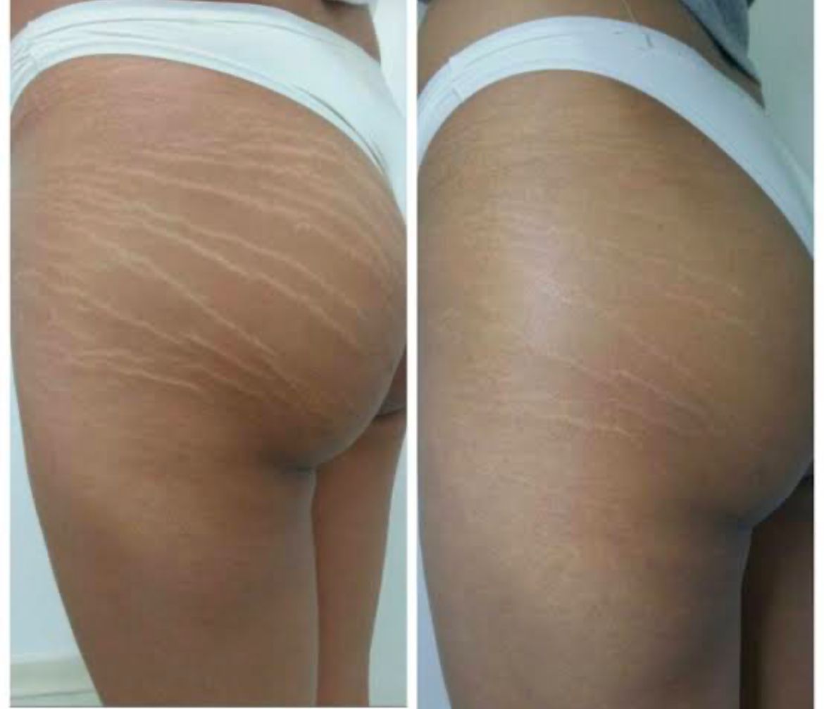 Antes e depois - Tratamento para estrias